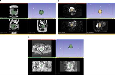 An MRI radiomics-based model for the prediction of invasion of the lymphovascular space in patients with cervical cancer